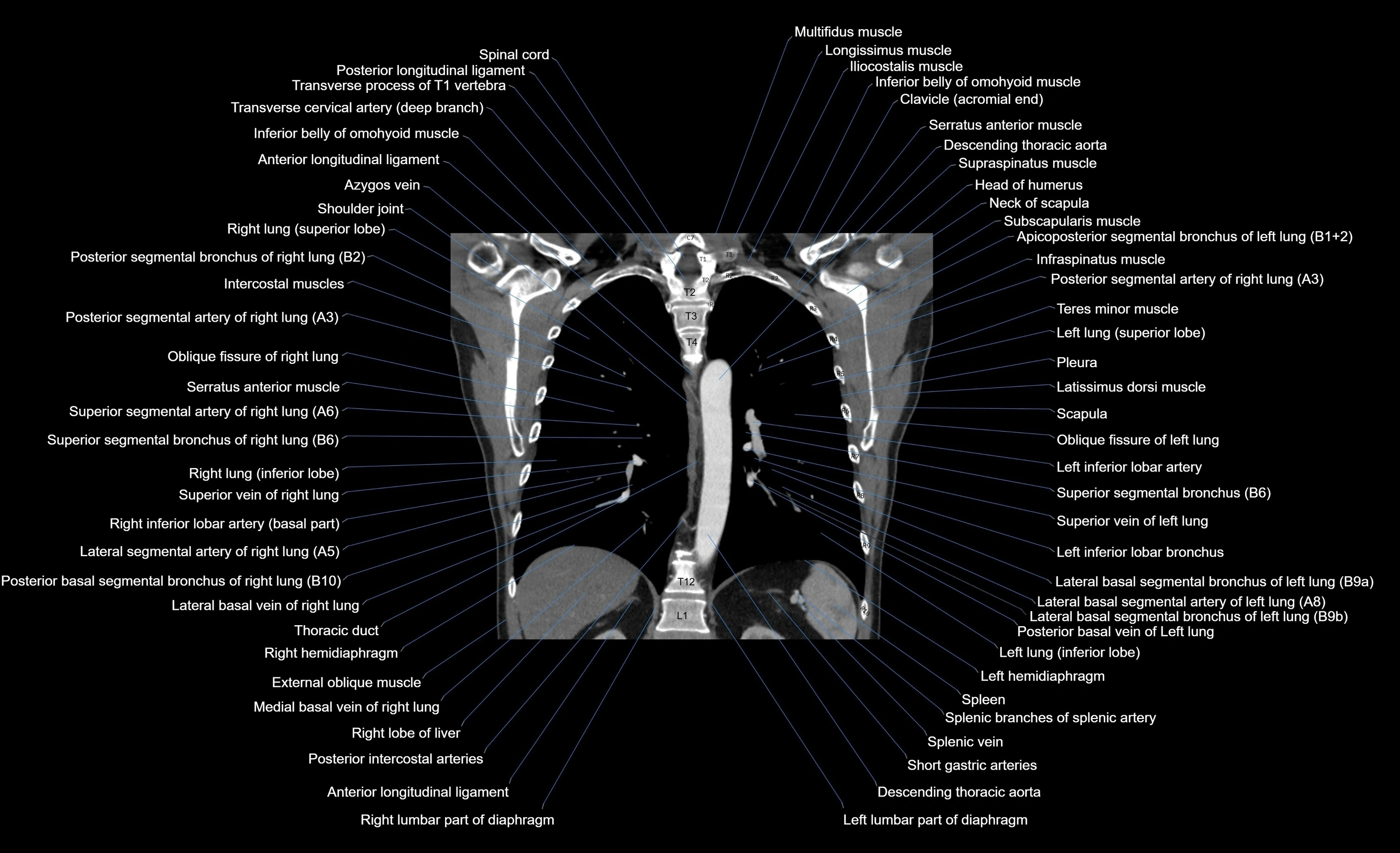 CT chest (thorax) soft tissue window labelled coronal cross sectional anatomy radiology image-00045.webp
